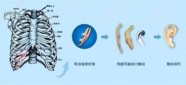 安波耳再造成效不差0失敗病例