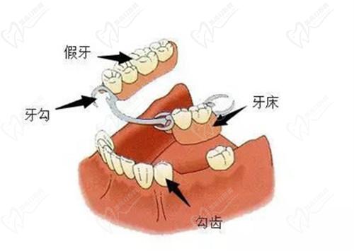 套筒冠義齒需要每天摘戴嗎？