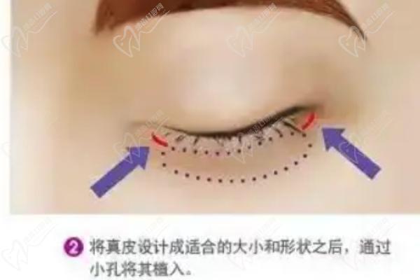 杜園園上瞼脂肪平鋪手術(shù)費用5W值嗎