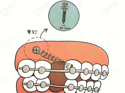 正畸打骨釘和不打骨釘?shù)膮^(qū)別