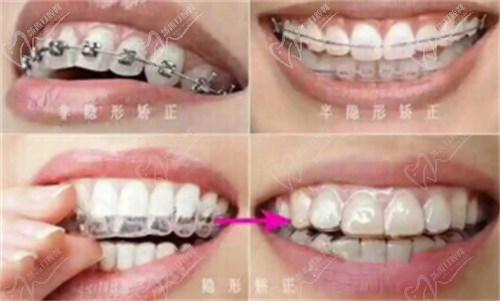 二、拜博口腔正畸價(jià)格的影響因素
