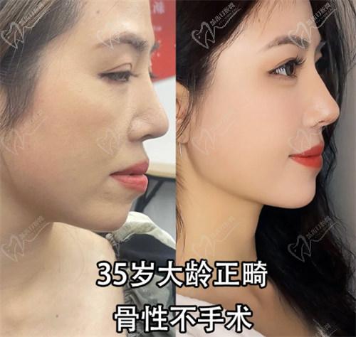國內牙齒矯正的流程：