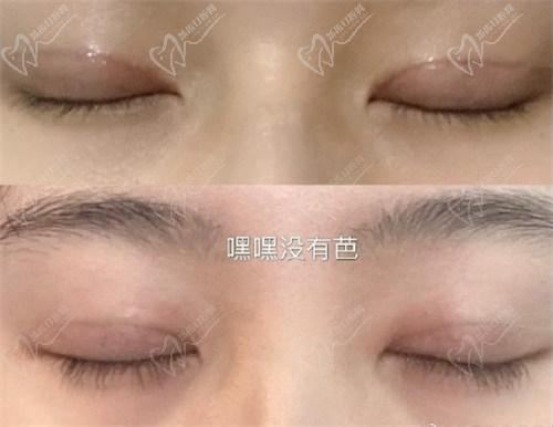 北京豐聯(lián)麗格醫(yī)療美容師麗麗修復(fù)雙眼皮怎么樣？