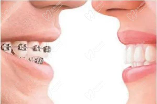 怎么區(qū)分正畸mbt與roth托槽？對(duì)比兩者區(qū)別來(lái)看哪個(gè)好附價(jià)格
