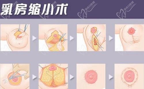 重慶劉正茂醫(yī)生縮胸怎么樣？