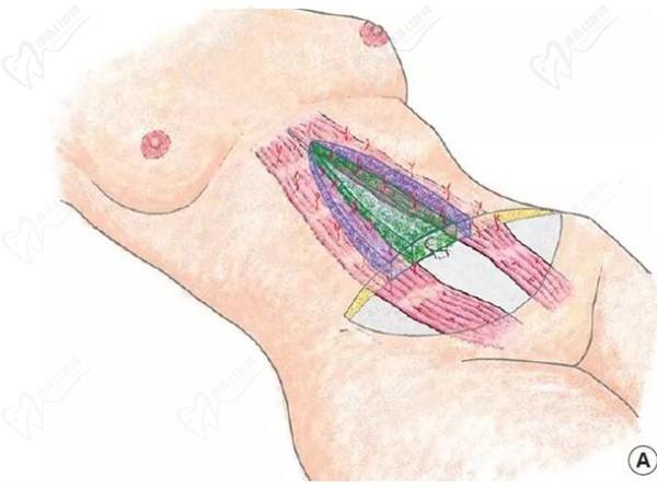 成都張航做腹壁整形靠譜，四川現(xiàn)代醫(yī)院張航腹部拉皮技術(shù)口碑不錯(cuò)|松弛肚皮變平整無(wú)疤痕更自然
